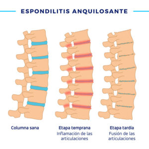 Qué es la espondilitis anquilosante y cuáles son sus síntomas