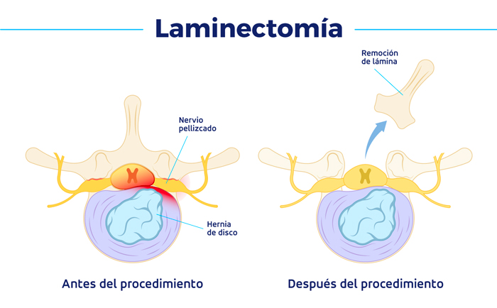 laminectomía